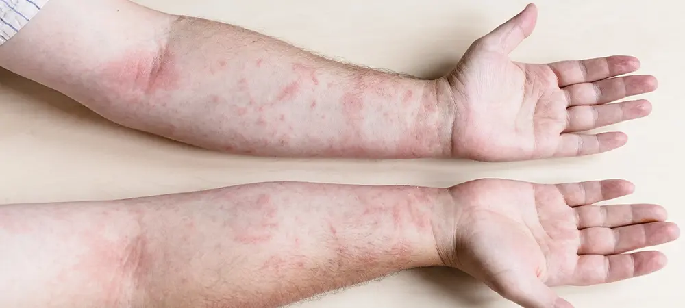 ¿Qué es el herpes zóster?